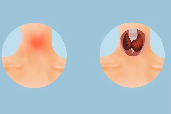 Ngày hôm sau, dù công việc vô cùng cần kíp nhưng Lin vẫn trình giấy phép xin nghỉ đi khám. Thật may, đây không phải khối u mà chỉ là một cục nhỏ do sưng hạch ở cổ mà thôi.