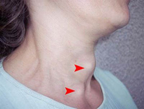 Trong khi đó, u ác tính lại có đặc điểm hoàn toàn trái ngược. Bề ngoài u ác tính gồ ghề, không mịn. Sờ nắn sẽ thấy cứng như đá cuội.