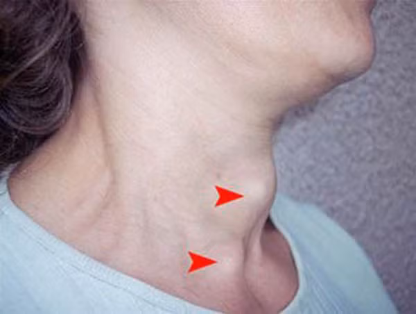 Trong khi đó, u ác tính lại có đặc điểm hoàn toàn trái ngược. Bề ngoài u ác tính gồ ghề, không mịn. Sờ nắn sẽ thấy cứng như đá cuội.