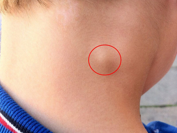 Theo bác sĩ, ở cơ thể người, hạch được phân bố gần như khắp cơ thể, từ trong phủ tạng, ổ bụng cho tới các phần mềm dưới da. Các hạch dễ sờ thấy nhất là hạch cổ, hạch bẹn và hạch nách.