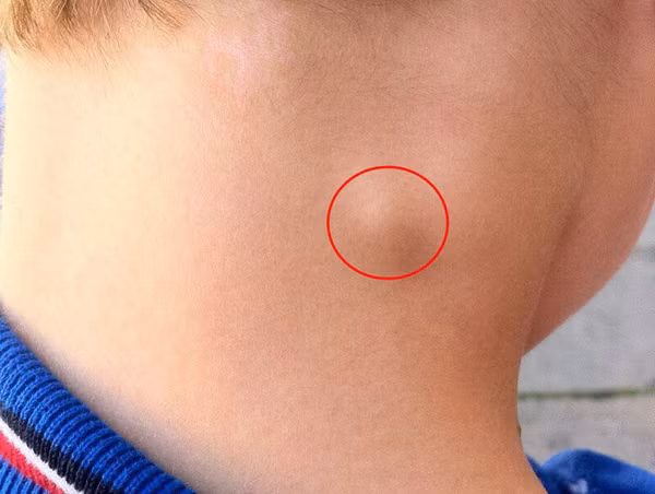 Theo bác sĩ, ở cơ thể người, hạch được phân bố gần như khắp cơ thể, từ trong phủ tạng, ổ bụng cho tới các phần mềm dưới da. Các hạch dễ sờ thấy nhất là hạch cổ, hạch bẹn và hạch nách.