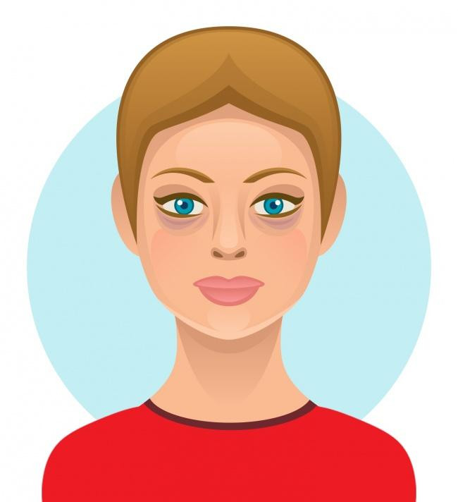 Rượu gián đoạn hormone dẫn đến mụn trứng cá. Rượu cũng làm suy yếu hệ thống miễn dịch bằng cách thay thế vi khuẩn rất quan trọng trong ruột là microbiome. Rượu còn làm mất nước khiến làn da sưng húp, sần sùi. Ảnh Brightside