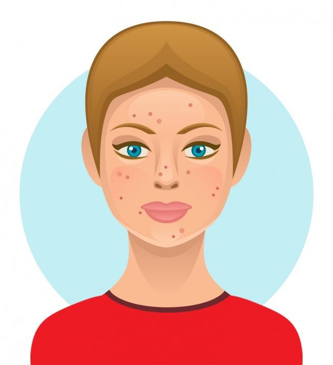 Thứ hai, có rất nhiều loại sữa chất lượng thấp dễ bị hỏng do quá trình thanh trùng, bay hơi, tách kem... Tất cả tạo ra các điều kiện hoàn hảo cho mụn trứng cá nảy nở. Bạn có thể muốn xem xét chuyển sang các lựa chọn thay thế, chẳng hạn như sữa dê hoặc mua sữa tươi. Ảnh Brightside