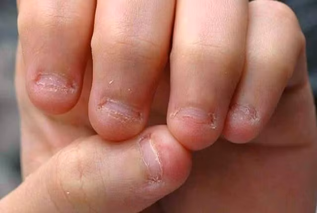 Bên cạnh đó, thói quen cắn móng tay có thể gây ra các vấn đề về răng, gây hỏng men răng, làm răng bị xô lệch và yếu dần đi. (Nguồn Wp)