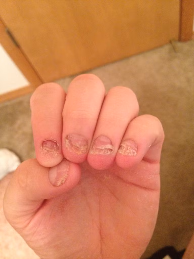 Đồng thời, khi cắn móng tay, nước bọt dính vào da và gây nên hiện tượng ăn mòn da. (Nguồn Imgur)