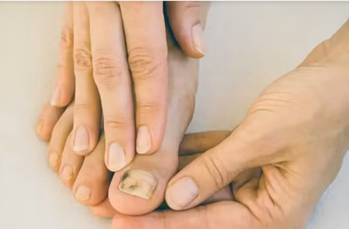 Dấu hiệu “lạ” ở ngón chân cảnh báo tế bào ung thư lộ diện - Hình 2 Dau hieu “la” o ngon chan canh bao te bao ung thu lo dien-Hinh-2