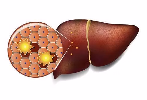 7 dau hieu co the canh bao gan nhiem mo