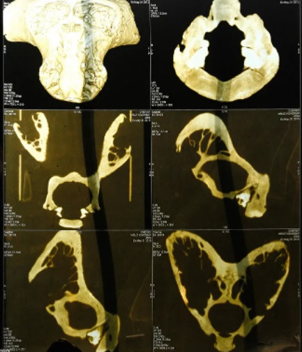 Theo giả thuyết này, chính quyền trùm phát xít Hitler có được 2 hộp sọ của người ngoài hành tinh nhưng không rõ bằng cách nào. Phát xít Đức có thể tìm thấy các hộp sọ đó trong các mộ cổ hoặc từng chạm trán, tiêu diệt sinh vật ngoài Trái đất.
