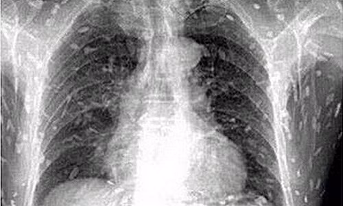 Chỗ nào cũng ngứa, suýt thiệt mạng vì nhiễm sán dây Cho nao cung ngua, suyt thiet mang vi nhiem san day