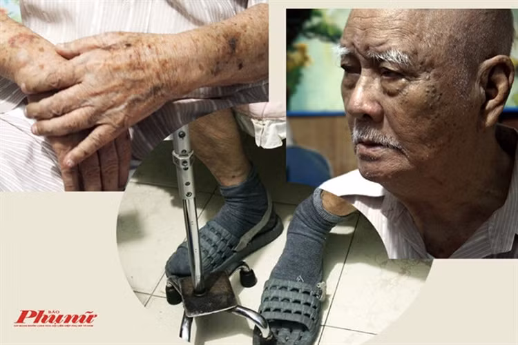 Gần đây, câu chuyện nhạc sĩ Nguyễn Văn Tý bị con cái bỏ rơi và sống chật vật lúc cuối đời gây xôn xao dư luận. Cụ thể, trong một bài phỏng vấn mới đây, nam nhạc sĩ kể ông mắc nhiều bệnh, trí nhớ giảm, tay chân rất yếu nên không thể đi đứng được. Ảnh: Báo phụ nữ