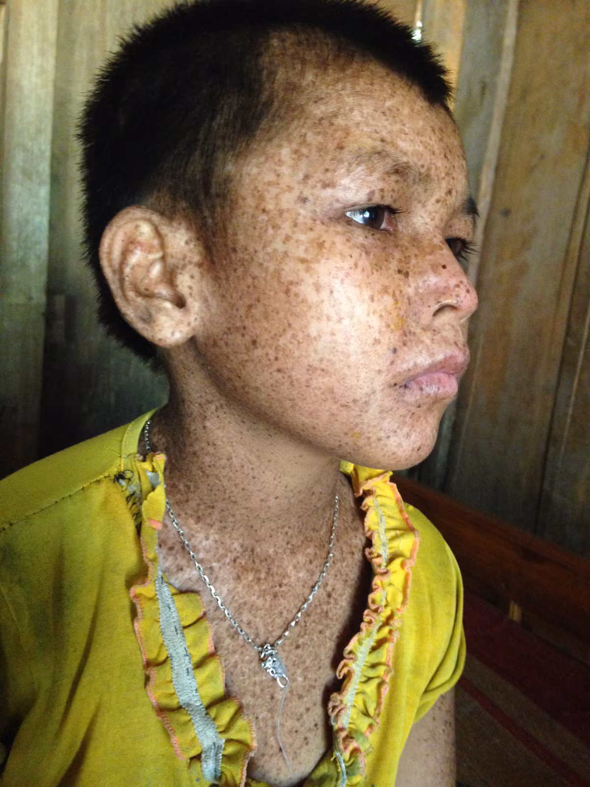 Dấu hiệu của bệnh xuất hiện rất sớm, thường là sau khi sinh từ 2 đến 5 tháng tuổi. Ban đầu, bệnh xuất hiện những vết xước, mụn nước màu hồng trên vùng đầu, mặt, sáu đó loét rỉ máu, rồi tự liền. (Hình ảnh cháu bé nhiễm bệnh ở Phú Thọ).