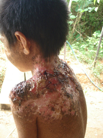 TS Lê Hữu Doanh, Phó Giám đốc bệnh viện Da liễu trung ương cho biết: "Từ năm 2009 tại bệnh viện Da liễu Trung ương cũng đã xuất hiện đơn lẻ những trường hợp bệnh nhân bị khô da sắc tố ở Hòa Bình và một số địa phương khác. (Hình ảnh một bệnh nhân bị khô da sắc tố ở Hòa Bình).