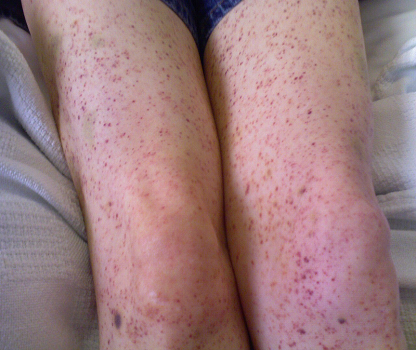 Loại biến chứng sốt xuất huyết thứ hai gây nguy hiểm là xuất huyết bất thường do rối loạn nguyên tố đông máu như: chảy máu cam dữ dội, rong kinh, chỗ chích bị bầm tím, xuất huyết đường tiêu hóa, xuất huyết nội tạng... Ở người lớn, khi mắc bệnh SXH, tỷ lệ xuất huyết não chiếm 1%, máu chảy lan nhiều chỗ trong não. Đây là nguyên nhân dẫn đến nguy cơ tử vong cao ở người lớn mắc bệnh SXH.