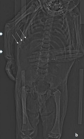 Đối với các nhà nghiên cứu, điều này cho thấy rằng mặc dù đứa trẻ mới biết đi đã được cho ăn đủ để tăng cân nhưng vẫn bị suy dinh dưỡng, hậu quả của việc bị giữ trong nhà không cho tiếp xúc với ánh nắng mặt trời khiến cơ thể cậu bé bị thiếu vitamin D.