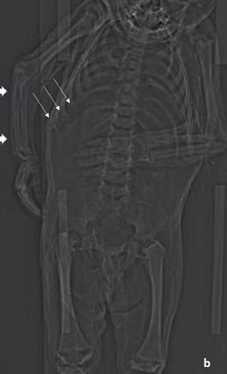 Đối với các nhà nghiên cứu, điều này cho thấy rằng mặc dù đứa trẻ mới biết đi đã được cho ăn đủ để tăng cân nhưng vẫn bị suy dinh dưỡng, hậu quả của việc bị giữ trong nhà không cho tiếp xúc với ánh nắng mặt trời khiến cơ thể cậu bé bị thiếu vitamin D.