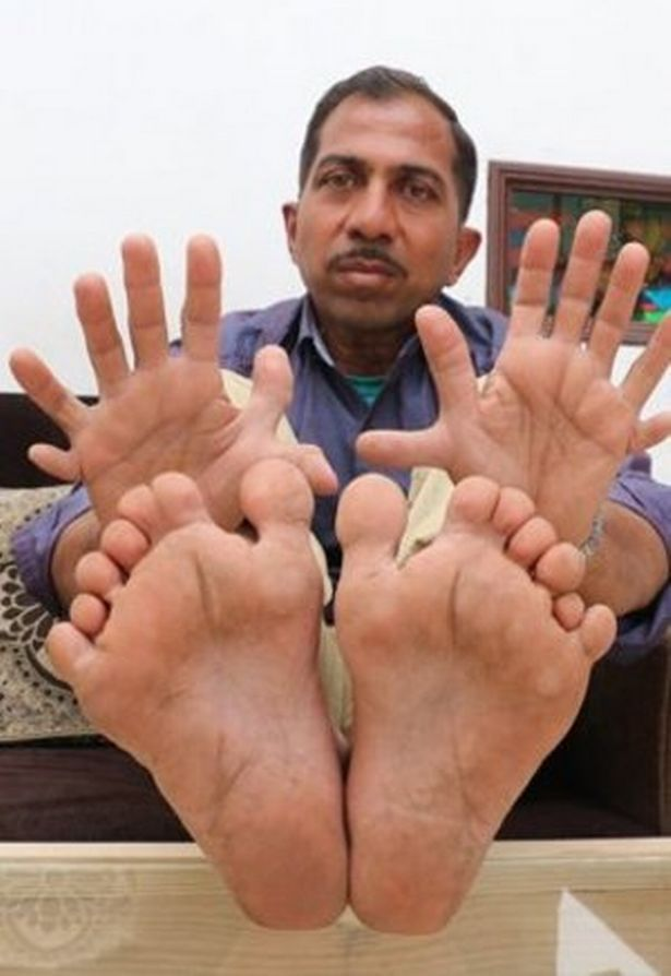 Suthar cho biết những ngón tay thừa không ảnh hưởng đến công việc thợ mộc của anh nhưng anh buộc phải đi giày được đặt làm đặc biệt.