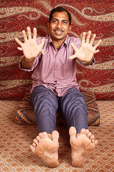  2. Devendra Suthar: Suthar mắc phải một tình trạng đặc biệt ngay từ khi vừa ra đời, khiến anh có nhiều ngón tay hơn bất kỳ ai khác trên thế giới. Anh có 7 ngón tay trên mỗi bàn tay và 7 ngón chân trên mỗi bàn chân.