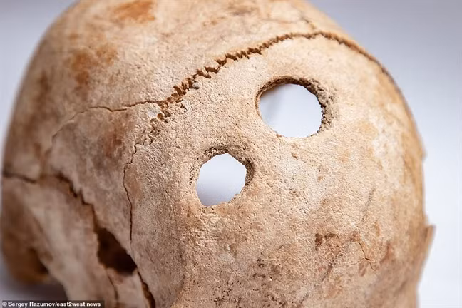 Theo một nghiên cứu năm 2011, việc khoan sọ trong thế giới cổ đại nhằm điều trị các vấn đề từ thể chất đến sức khỏe tâm thần. Nhóm nghiên cứu liệt kê ba lý do chính dẫn đến việc khoan sọ vào thời kỳ Đồ Đá Mới.