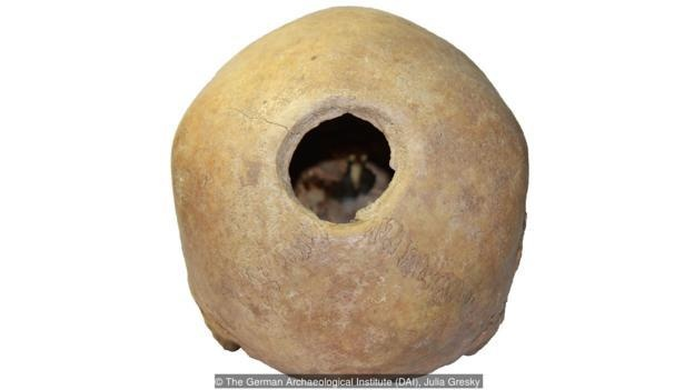 Một bí ẩn khác về hộp sọ niên đại 3.200 năm ở tỉnh Van là người này có sống sót sau cuộc phẫu thuật hay không. Dù phần bị loại bỏ ngày nay trông khá sạch sẽ, không phải bệnh nhân nào cũng sống sót qua quá trình khoan, cắt, cưa và khoét lỗ trên hộp sọ. Tuy nhiên, bằng chứng từ Peru cho thấy nhiều người đã vượt qua được, bao gồm hơn 100 cư dân của Đế chế Inca.