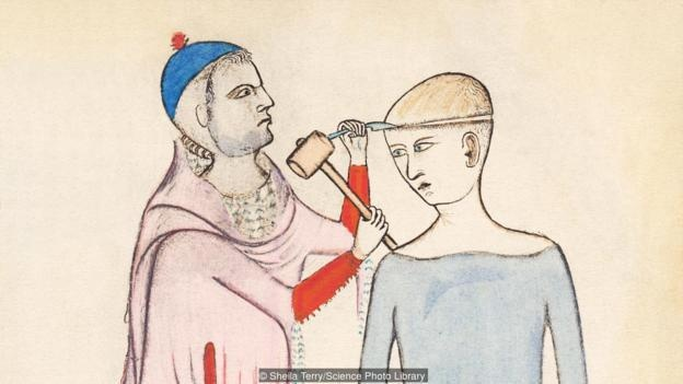 “Chúng tôi đưa ra giả thiết rằng người phụ nữ mang thai đã bị tiền sản giật hoặc sản giật (2 điều kiện mang thai liên quan đến huyết áp cao) và cô ấy đã được phẫu thuật trepanning trực diện để giảm áp lực nội sọ. Dù vậy, cô ấy đã không vượt qua được ca phẫu thuật và qua đời với thai nhi trong bụng.” - theo ghi chép của các nhà nghiên cứu trong tập World Neurosurgery vào tháng 5/2018.