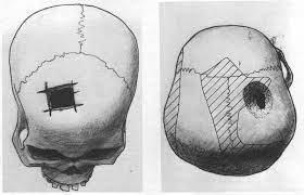Theo bác sĩ giải phẫu thần kinh Raphael Davis, phẫu thuật khoan sọ (Trepanation) - còn được gọi là trephination - “đã xuất hiện từ 5.000 năm trước và được biết đến như một trong những thủ thuật y học lâu đời nhất trong lịch sử loài người”.