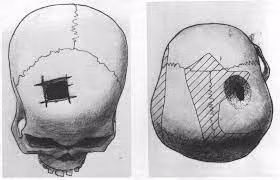 Theo bác sĩ giải phẫu thần kinh Raphael Davis, phẫu thuật khoan sọ (Trepanation) - còn được gọi là trephination - “đã xuất hiện từ 5.000 năm trước và được biết đến như một trong những thủ thuật y học lâu đời nhất trong lịch sử loài người”.