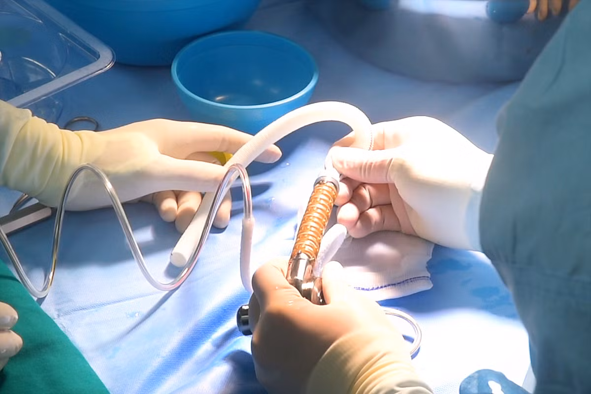 Vinmec cay ghep thanh cong tim nhan tao ho tro tam that cho benh nhan suy tim giai doan cuoi-Hinh-5