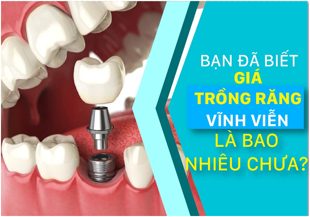 Ban da biet gia trong rang vinh vien la bao nhieu chua?