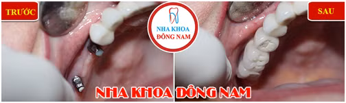 Ban da biet gia trong rang vinh vien la bao nhieu chua?-Hinh-3