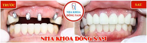 Ban da biet gia trong rang vinh vien la bao nhieu chua?-Hinh-5