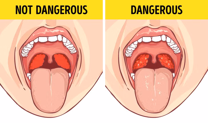  Đau họng và đổi giọng. Vào một buổi sáng, khu thức dậy, bạn bỗng thấy mình bị đau họng và đổi giọng mà không có thêm bất cứ triệu chứng bệnh tật nào khác như sốt hoặc tắc mũi. Đừng lo lắng. Rất có thể nguyên nhân là do vi khuẩn hoặc vi rút.