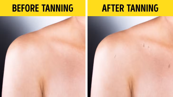  Các đốm đen trên da. Chắc hẳn, nhiều người sẽ liên tưởng tới bệnh ung thư da khi trông thấy các đốm đen xuất hiện trên da. Tuy nhiên, có nhiều yếu tố khác dẫn tới việc đó, như căng thẳng, thiếu vitamin, thay đổi cân bằng hooc-mon trong thời kỳ thai nghén.