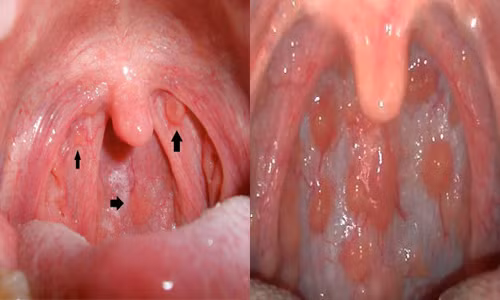 Dấu hiệu này là do họng bị đau làm ảnh hưởng đến các cơ quan khác trên đường hô hấp, và làm hệ miễn dịch suy giảm tạo điều kiện cho virus, vi khuẩn gây bệnh. Ảnh: namlimxanh.