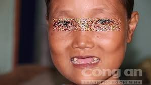 Thực tế, những người chứng bệnh ăn uống vô độ như chị Nguyễn Thị Như Ý ở Điện Bàn Quảng Nam còn phải chịu rất nhiều những ảnh hưởng nghiêm trọng khác do căn bệnh mình mắc phải, thậm chí có thể nguy hiểm đến tính mạng.