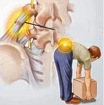 Việc bạn mắc căn bệnh thoát vị đĩa đệm cũng có thể do nguyên nhân di truyền. Nếu bố mẹ có đĩa đệm yếu do bất thường về cấu trúc thì con cái cũng dễ bị thoát vị đĩa đệm.