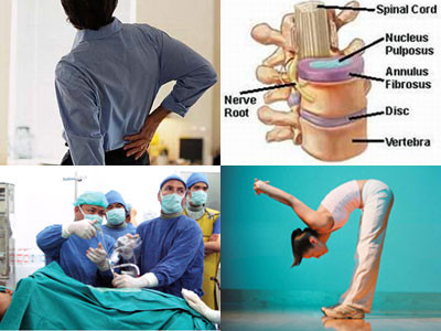 Đĩa đệm là một bộ phận nằm ở giữa liên đốt sống cấu tạo là những bao sơ dày chắc bao bọc một lớp nhầy bên trong có chức năng co dãn, chống sóc để cột sống hoạt động dễ dàng. Khi các bao sơ này bị rách các lớp nhân nhầy thoát ra ngoài thì khi đó bạn đã mắc phải căn bệnh thoát vị đĩa đệm như người mẫu Thái Hà.