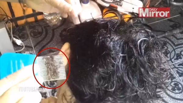 Nhũng truòng họp rạn mu ký sinh lúc nhúc dụng tóc gáy-Hinh-4