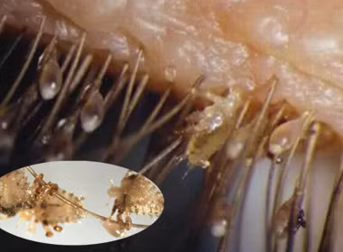 Cháu bé 6 tuổi bị rận mu bám đầy mí mắt. Vào tháng 10/2014, cháu bé Nguyễn T A 6 tuổi ở quận 7, Tp. HCM phải nhập viện vì hàng chục con rận mu tấn công và ký sinh trên mắt cũng như mi mắt.