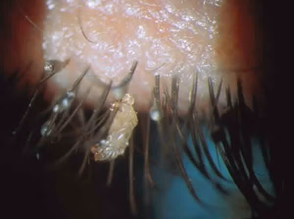 Gia đình cháu T. A cho biết cháu bé hay bị ngứa mi mắt cả hai bên và hay chớp mắt. Khi gia đình đưa cháu A đến bệnh viện khám, các bác sĩ phát hiện mi mắt hai bên của bé đóng vảy, mẩn đỏ, ngứa. Trên đầu bé phát hiện các vảy rải rác, da đầu có các nốt thâm nhiễm, bé hay ngứa về đêm.