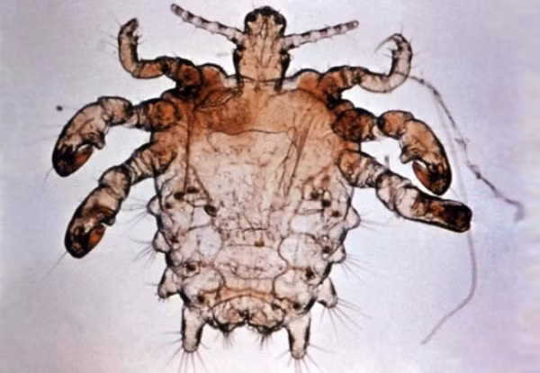 Bé gái 4 tuổi bị hàng chục con rận hút máu. Ngày 10/3/2015, các bác sĩ tại Bệnh viện Đa khoa Quảng Nam cho biết, đã tiến hành gắp chục con rận hút máu trong mắt bé gái 4 tuổi thành công.