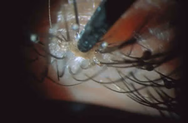 Thông tin về cô gái trên được lan truyền rộng rãi khắp nơi sau khi clip mẹ cô tìm cách chải hàng triệu những con rận và trứng rận đã đóng kén khỏi mái tóc con gái.