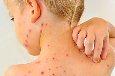 Dấu hiệu nặng hơn của bệnh sốt xuất huyết là sốc. Dấu hiệu này thường xuất hiện từ ngày thứ 3-6 của bệnh, đặc biệt lúc trẻ đang sốt cao chuyển sang hết sốt và có thể xảy ra kể cả khi không thấy rõ dấu hiệu xuất huyết.