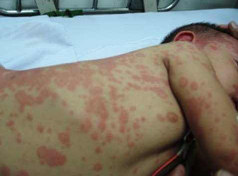 Người bị sốc do sốt xuất huyết thường mệt, ngủ li bì, chân tay rất lạnh tiểu ít. Kèm với đó là tình trạng nôn ói đi ngoài ra máu.