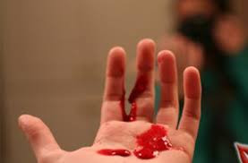 Những người bị ung thư phổi khi bị ho thường có nhiều đờm, trong đờm có lẫn máu.