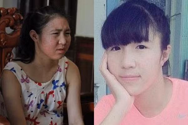 Nu tuyen thu bong da mac benh hiem ngheo nguy kich-Hinh-2