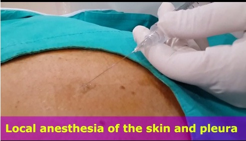 Theo một chia sẻ của TS. Nguyễn Thanh Hồi, khoa Hô hấp, Bệnh viện Bạch Mai, ở Việt Nam hiện nay, viêc sinh thiết phổi thường được thực hiện qua thành ngực dưới hướng dẫn của chụp cắt lớp vi tính. Để sinh thiết phổi, đầu tiên bệnh nhân sẽ được tiêm 2 ống atropin 0,25mg dưới da trước khi tiến hành 15 phút.