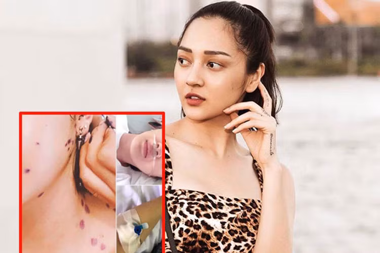 Tháng 4/2018, Bảo Anh hủy show sau khi nhập viện do làm việc quá sức trong nhiều ngày. Cô bị sốt cao, đau họng sau đó bị phát bệnh thủy đậu. Ảnh: Danviet