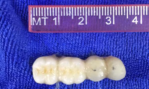 Cụ ông 90 tuổi suýt chết do... răng giả Cu ong 90 tuoi suyt chet do... rang gia