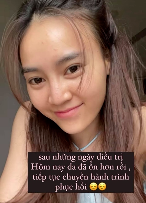 Lan Ngọc chăm sóc da mặt kỹ lưỡng khi bị nổi mụn. Ảnh: FBNV