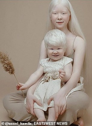 Theo đó, hai chị em Asel (14 tuổi) và Kamila (2 tuổi) bị chứng bạch tạng từ khi sinh ra.